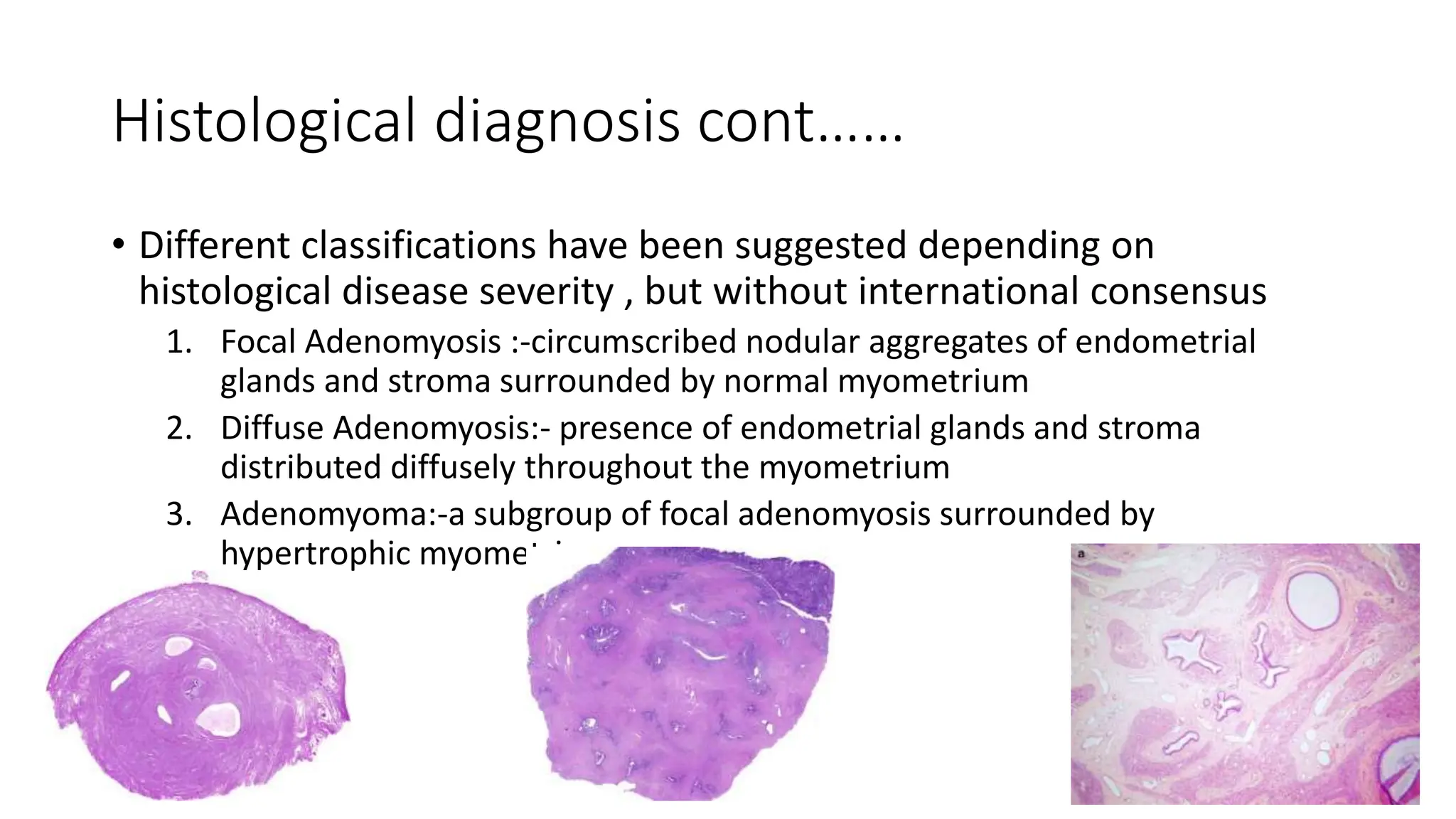 Diagnosing adenomyosis .pptx