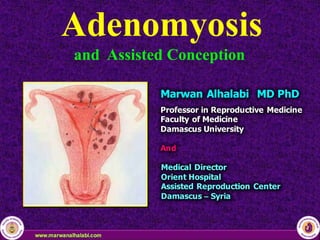 Adenomyosis
and Assisted Conception
Marwan Alhalabi MD PhD
Professor in Reproductive Medicine
Faculty of Medicine
Damascus University
And
Medical Director
Orient Hospital
Assisted Reproduction Center
Damascus – Syria
 