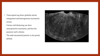 • Transvaginal usg shows globular uterine
enlargement and heterogeneous myometrial
texture.
Uterine wall thickening can show
anteroposterior asymmetry, and here the
posterior wall is thicker.
The endo-myometrial junction is also poorly
defined
 