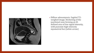• Diffuse adenomyosis: Sagittal T2-
weighed image; thickening of the
junctional zone forming an ill-
defined area of low signal intensity,
with punctate high-intensity
myometrial foci (white arrow)
 