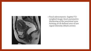 • Focal adenomyosis: Sagittal T2-
weighed image; focal asymmetric
thickening of the junctional zone
forming an ill-defined area of low
signal intensity (black arrow)
 