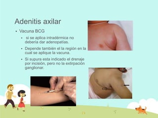 Adenitis axilar


Vacuna BCG


si se aplica intradérmica no
debería dar adenopatías.



Depende también el la región en la
cual se aplique la vacuna.



Si supura esta indicado el drenaje
por incisión, pero no la extirpación
ganglionar.

 