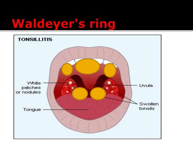 Adenotonsillitis.pptx