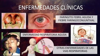 ENFERMEDADES CLÍNICAS
FARINGITIS FEBRIL AGUDA Y
FIEBRE FARINGOCONJUNTIVAL
ENFERMEDAD RESPIRATORIA AGUDA
OTRAS ENFERMEDADES DE LAS
VIAS RESPIRATORIAS
 