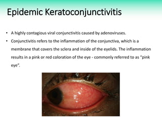 Epidemic Keratoconjunctivitis
• A highly contagious viral conjunctivitis caused by adenoviruses.
• Conjunctivitis refers to the inflammation of the conjunctiva, which is a
membrane that covers the sclera and inside of the eyelids. The inflammation
results in a pink or red coloration of the eye - commonly referred to as “pink
eye”.
 