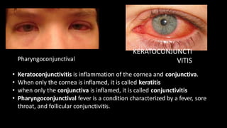 Pharyngoconjunctival
KERATOCONJUNCTI
VITIS
• Keratoconjunctivitis is inflammation of the cornea and conjunctiva.
• When only the cornea is inflamed, it is called keratitis
• when only the conjunctiva is inflamed, it is called conjunctivitis
• Pharyngoconjunctival fever is a condition characterized by a fever, sore
throat, and follicular conjunctivitis.
 