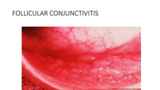 FOLLICULAR CONJUNCTIVITIS
 