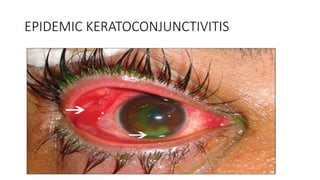 EPIDEMIC KERATOCONJUNCTIVITIS
 