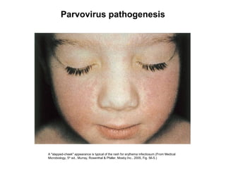 A "slapped-cheek" appearance is typical of the rash for erythema infectiosum.(From Medical
Microbiology, 5th
ed., Murray, Rosenthal & Pfaller, Mosby Inc., 2005, Fig. 56-5.)
Parvovirus pathogenesis
 