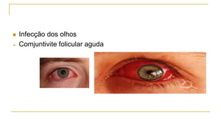  Infecção dos olhos
 Comjuntivite folicular aguda
 