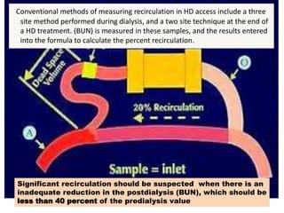 Nhs Recirculate Adequacy of Hemodialysis | PPTX