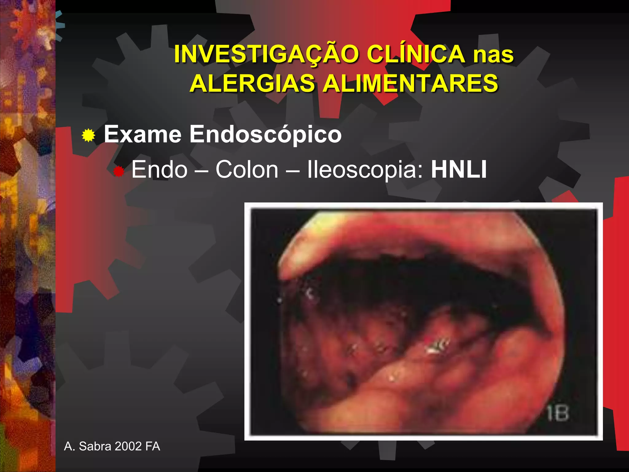 INVESTIGAÇÃO CLÍNICA nas
ALERGIAS ALIMENTARES
 Exame Endoscópico
 Endo – Colon – Ileoscopia: HNLI
A. Sabra 2002 FA
 