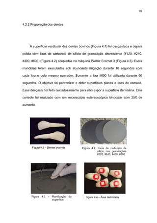 99




4.2.2 Preparação dos dentes




     A superfície vestibular dos dentes bovinos (Figura 4.1) foi desgastada e depois

polida com lixas de carbureto de silício de granulação decrescente (#120, #240,

#400, #600) (Figura 4.2) acopladas na máquina Politriz Ecomet 3 (Figura 4.3). Estas

manobras foram executadas sob abundante irrigação durante 10 segundos com

cada lixa e pelo mesmo operador. Somente a lixa #600 foi utilizada durante 60

segundos. O objetivo foi padronizar e obter superfícies planas e lisas de esmalte.

Esse desgaste foi feito cuidadosamente para não expor a superfície dentinária. Este

controle foi realizado com um microscópio estereoscópico binocular com 25X de

aumento.




      Figura 4.1 – Dentes bovinos        Figura 4.2: Lixas de carbureto de
                                                     silício nas granulações
                                                     #120, #240, #400, #600




      Figura 4.3 – Planificação da          Figura 4.4 – Área delimitada
                   superfície
 