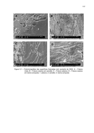 117




 A                                              B

               1
                                                            2

                               2




 C                                                D

                      1                                         3




Figura 5.1 – Fotomicrografias das superfícies fraturadas com aumento de 350X. A – Fratura
             mista; B – Fratura coesiva em esmalte; C – Fratura adesiva; D – Fratura coesiva
             em resina composta; 1: adesivo; 2: esmalte; 3: resina composta
 
