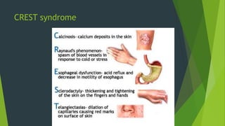 CREST syndrome
 