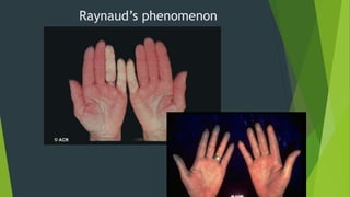 Raynaud’s phenomenon
 