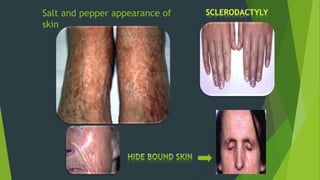 Salt and pepper appearance of
skin
 