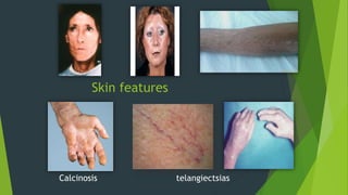 Skin features
Calcinosis telangiectsias
 