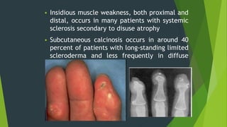  Insidious muscle weakness, both proximal and
distal, occurs in many patients with systemic
sclerosis secondary to disuse atrophy
 Subcutaneous calcinosis occurs in around 40
percent of patients with long-standing limited
scleroderma and less frequently in diffuse
disease
 