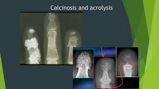 Calcinosis and acrolysis
 