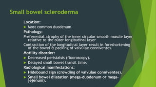 Small bowel scleroderma
Location:
 Most common duodenum.
Pathology:
Preferential atrophy of the inner circular smooth muscle layer
relative to the outer longitudinal layer
Contraction of the longitudinal layer result in foreshortening
of the bowel & packing of valvulae conniventes.
Motility disorder:
 Decreased peristalsis (fluoroscopy).
 Delayed small bowel transit time.
Radiological manifestations:
 Hidebound sign (crowding of valvulae conniventes).
 Small bowel dilatation (mega-duodenum or mega-
jejenum).
 