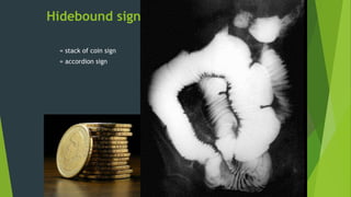 Hidebound sign
= stack of coin sign
= accordion sign
 