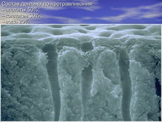 Состав дентина до протравливанияСостав дентина до протравливания::
--апатиты 50%--апатиты 50%;;
--коллаген 30%--коллаген 30%;;
--вода 20%.--вода 20%.
 