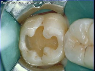 Препарирование кариозной полостиПрепарирование кариозной полости
 