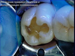Нанесение праймера и адгезив иНанесение праймера и адгезив и
полимеризация полимеризацияполимеризация полимеризация
 