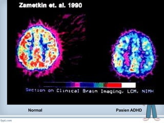 Adhd | PDF