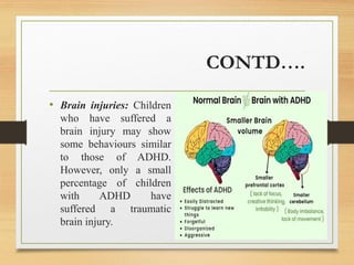 ADHD.pptx, HYPERKINETIC DISORDER | PPTX