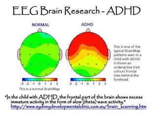 ADHD (2). Definition , diagnostic criteria | PPTX