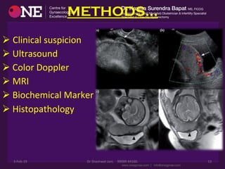 METHODS…
Ø Clinical	
  suspicion	
  	
  
Ø 	
  Ultrasound	
  
Ø 	
  Color	
  Doppler	
  
Ø 	
  MRI	
  
Ø 	
  Biochemical	
  Marker	
  
Ø 	
  Histopathology	
  
3-­‐Feb-­‐19	
   Dr	
  Shashwat	
  Jani.	
  	
  	
  	
  99099	
  44160.	
   13	
  
 