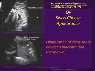 Moth	
  –	
  eaten	
  	
  
	
  OR	
  	
  	
  
Swiss	
  Cheese	
  
Appearance	
  	
  
3-­‐Feb-­‐19	
   Dr	
  Shashwat	
  Jani.	
  	
  	
  	
  99099	
  44160.	
   16	
  
Oblitera%on	
  of	
  clear	
  space	
  
between	
  placenta	
  and	
  
uterine	
  wall	
  
 