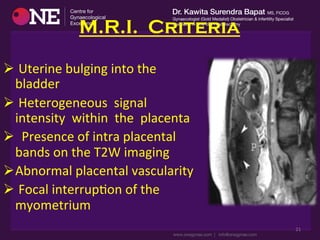  	
  	
  	
  M.R.I. Criteria
Ø 	
  Uterine	
  bulging	
  into	
  the	
  
bladder	
  
Ø 	
  Heterogeneous	
  	
  signal	
  	
  
intensity	
  	
  within	
  	
  the	
  	
  placenta	
  
Ø 	
  	
  Presence	
  of	
  intra	
  placental	
  
bands	
  on	
  the	
  T2W	
  imaging	
  
Ø Abnormal	
  placental	
  vascularity	
  
Ø 	
  Focal	
  interrupDon	
  of	
  the	
  
myometrium	
  
21	
  
 