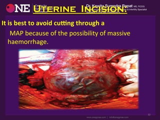 Uterine Incision:
It	
  is	
  best	
  to	
  avoid	
  cu3ng	
  through	
  a	
  
	
  	
  	
  	
  	
  MAP	
  because	
  of	
  the	
  possibility	
  of	
  massive	
  
haemorrhage.	
  
32	
  
 