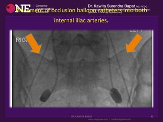 Placement	
  of	
  occlusion	
  balloon	
  catheters	
  into	
  both	
  
internal	
  iliac	
  arteries.	
  
DR.	
  KAWITA	
  BAPAT	
   37	
  
 