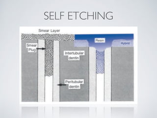 SELF ETCHING
 