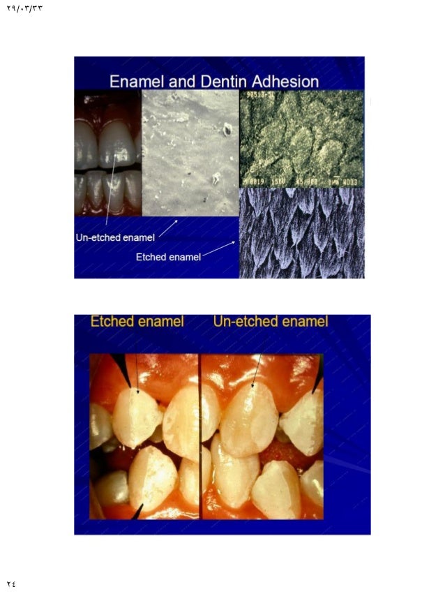 Adhesion in restorative dentistry