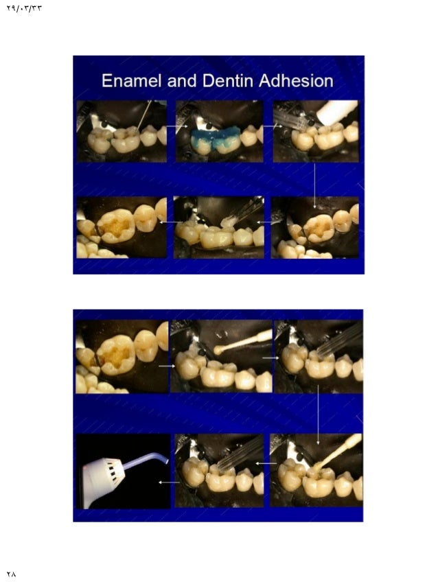 Adhesion in restorative dentistry