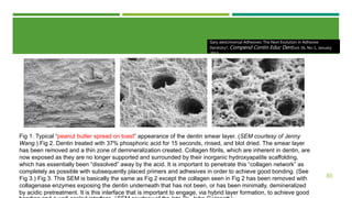 Smearing Adhesion Example Adhesion & Bonding in Dentistry | PPTX