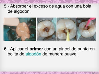 5.- Absorber el exceso de agua con una bola
de algodón.
6.- Aplicar el primer con un pincel de punta en
bolita de algodón de manera suave.
 