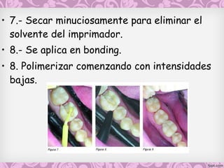 • 7.- Secar minuciosamente para eliminar el
solvente del imprimador.
• 8.- Se aplica en bonding.
• 8. Polimerizar comenzando con intensidades
bajas.
 