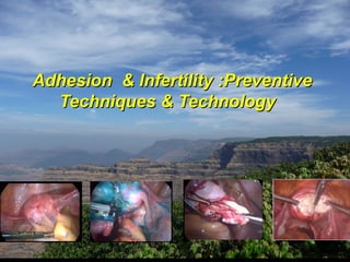 Adhesion & Infertility :PreventiveAdhesion & Infertility :Preventive
Techniques & TechnologyTechniques & Technology
 
