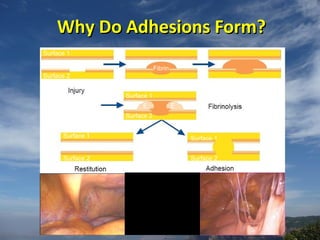 Adhesion Examples Infection Adhesion prevention | PPT