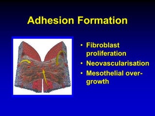 Adhesion Formation
• Fibroblast
proliferation
• Neovascularisation
• Mesothelial over-
growth
 