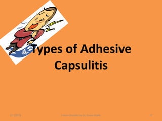 Types of Adhesive
Capsulitis
1/13/2021 Frozen Shoulder by Dr. Shazia Khalfe 12
 