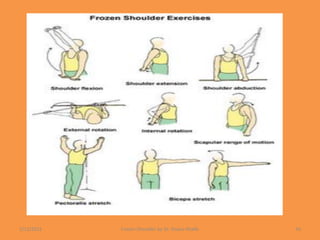 1/13/2021 Frozen Shoulder by Dr. Shazia Khalfe 43
 