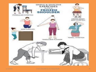 1/13/2021 Frozen Shoulder by Dr. Shazia Khalfe 45
 