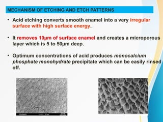 MECHANISM OF ETCHING AND ETCH PATTERNS
• Acid etching converts smooth enamel into a very irregular
surface with high surface energy.
• It removes 10µm of surface enamel and creates a microporous
layer which is 5 to 50µm deep.
• Optimum concentrations of acid produces monocalcium
phosphate monohydrate precipitate which can be easily rinsed
off.
 